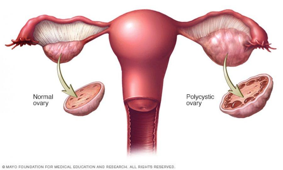 متلازمة تكيّس المبايض (PCOS) والسمنة