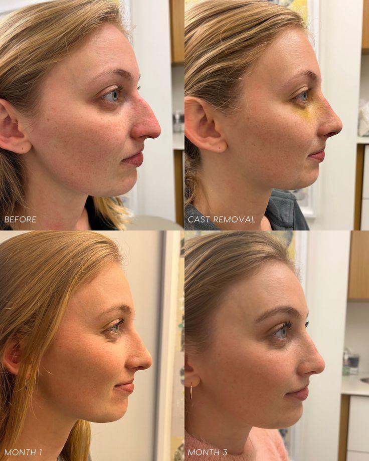 تجميل الأنف المحافظ (Preservation Rhinoplasty)