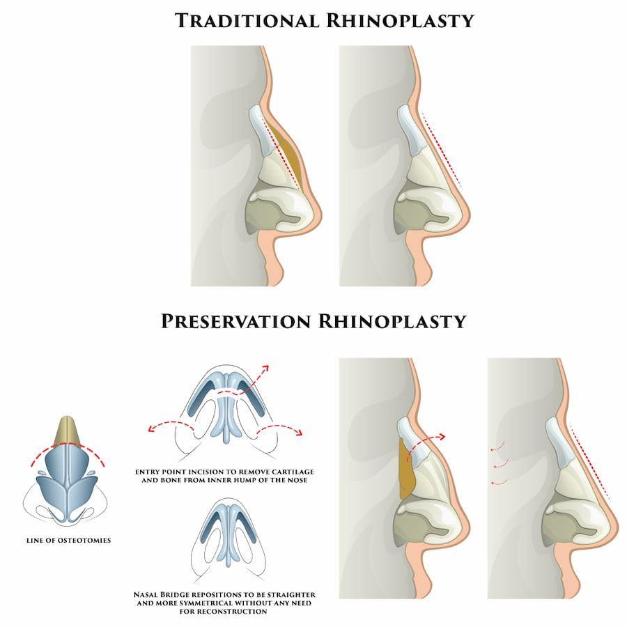 تجميل الأنف المحافظ- (Preservation Rhinoplasty)