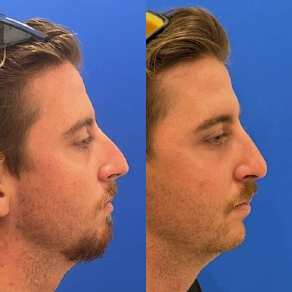 تجميل الأنف المحافظ (Preservation Rhinoplasty)