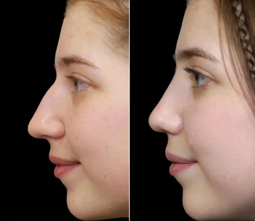 صور قبل وبعد عمليات تجميل الأنف